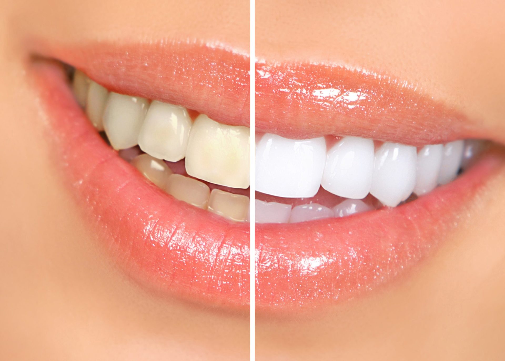 Quatro dicas para ter os dentes mais brancos
