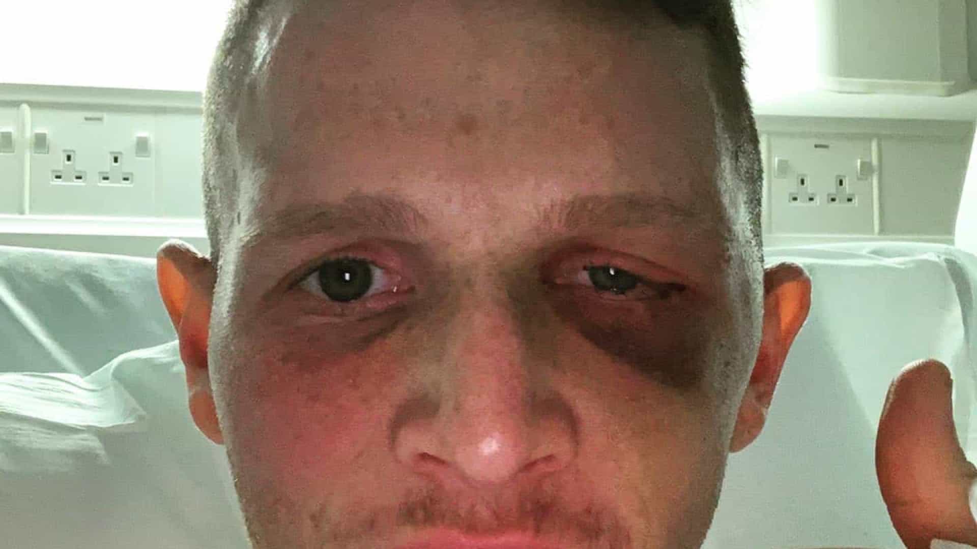 Jogador de hóquei perde visão do olho esquerdo e leva 40 pontos na cabeça depois de levar com bola