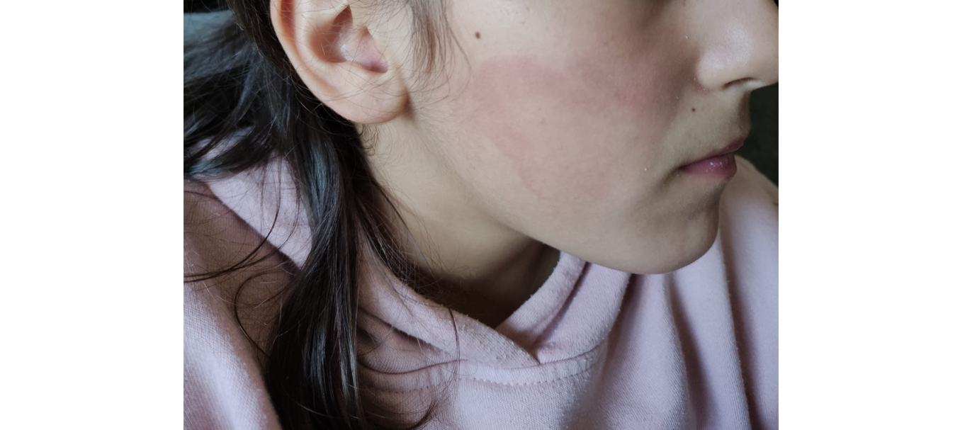 Menina de 10 anos agredida em escola no Cacém. “A minha filha não pode chegar assim a casa e ninguém fazer nada”
