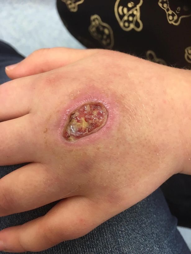 Criança de 8 anos fica com buraco na mão após ser picada por aranha