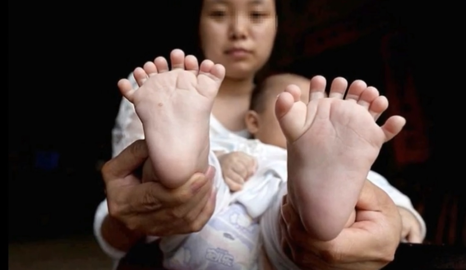 Bebé nasce com 31 dedos