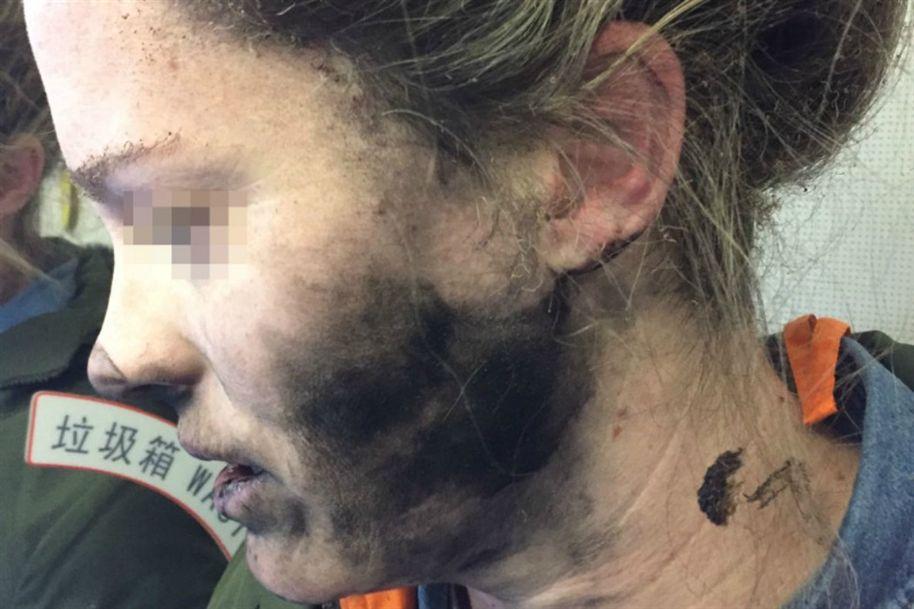 Mulher fica queimada após auscultadores terem explodido