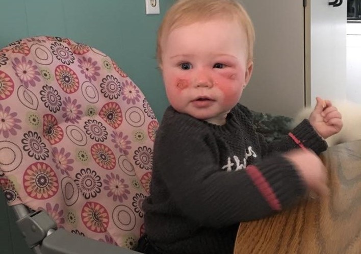 Bebé sofre queimaduras graves após aplicação de protetor solar