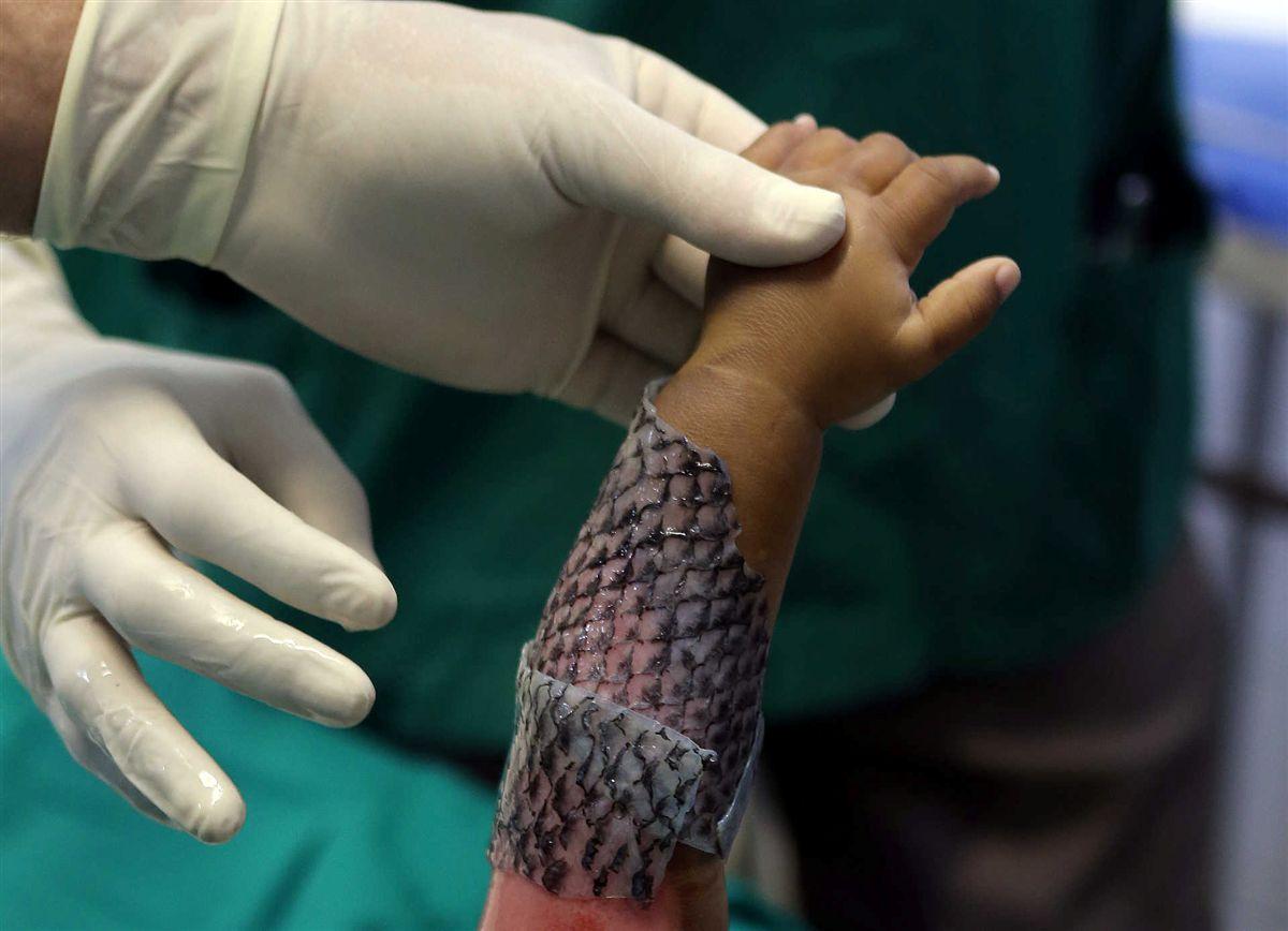 Brasil. Hospitais usam pele de peixe para tratar queimaduras