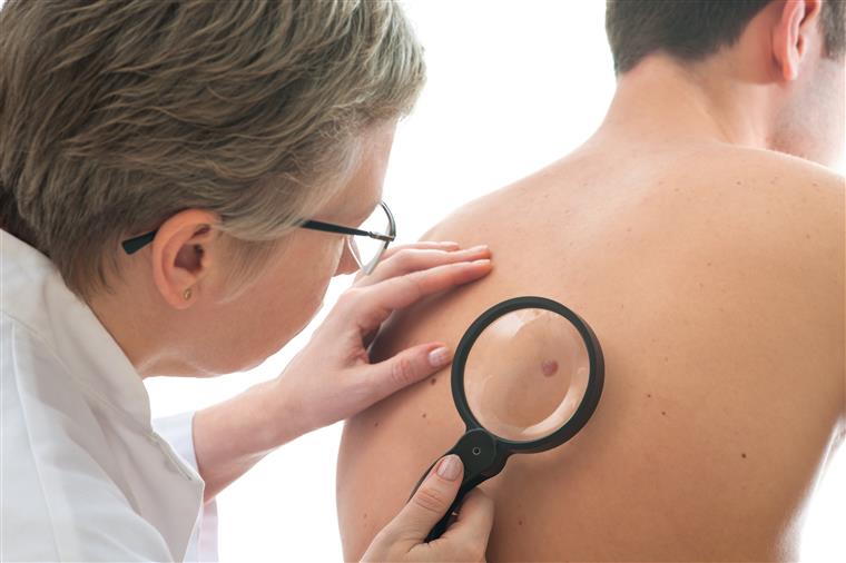Estes sintomas de cancro da pele não são tão visíveis, mas é preciso estar atento