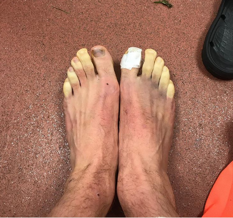 Jogador do Liverpool mostra fotografia com os dedos dos pés congelados