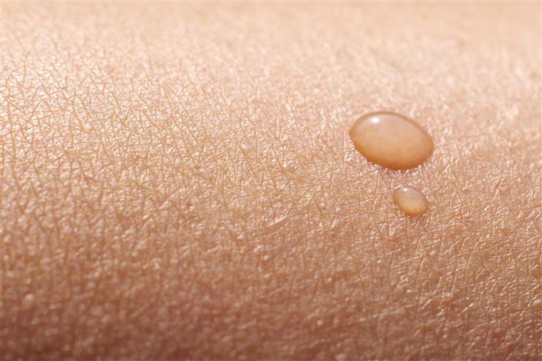 Casos de cancro da pele vão aumentar significativamente este ano