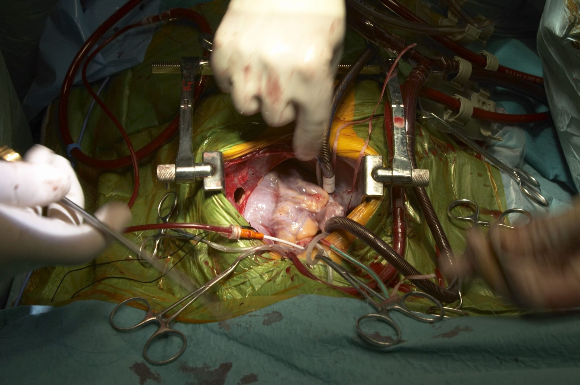 Órgãos de mulher transplantados transmitiram cancro aos recetores