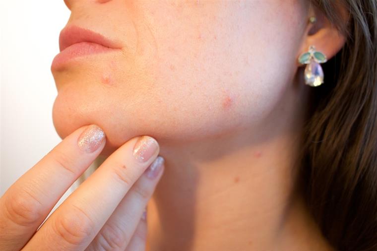 Sofre muito com a acne? A ‘cura milagrosa’ pode estar a caminho