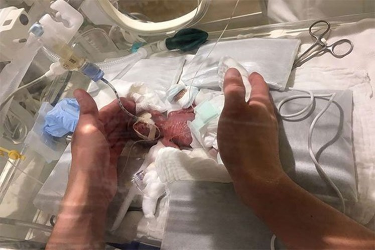 Bebé que nasceu com 268 gramas e que foi considerado o mais pequeno do mundo já teve alta
