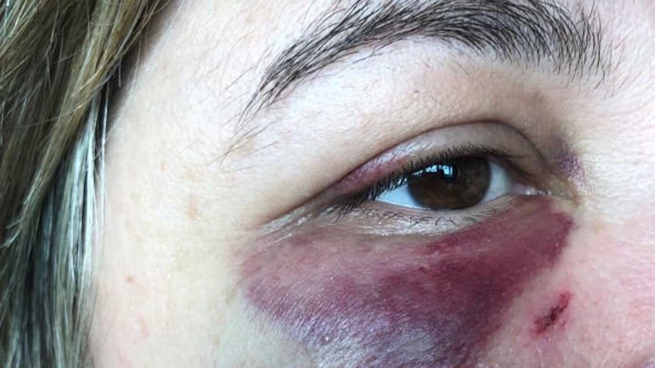 Fotografia mostra brutalidade do ataque a mulher de dirigente do Sporting no Dragão Caixa