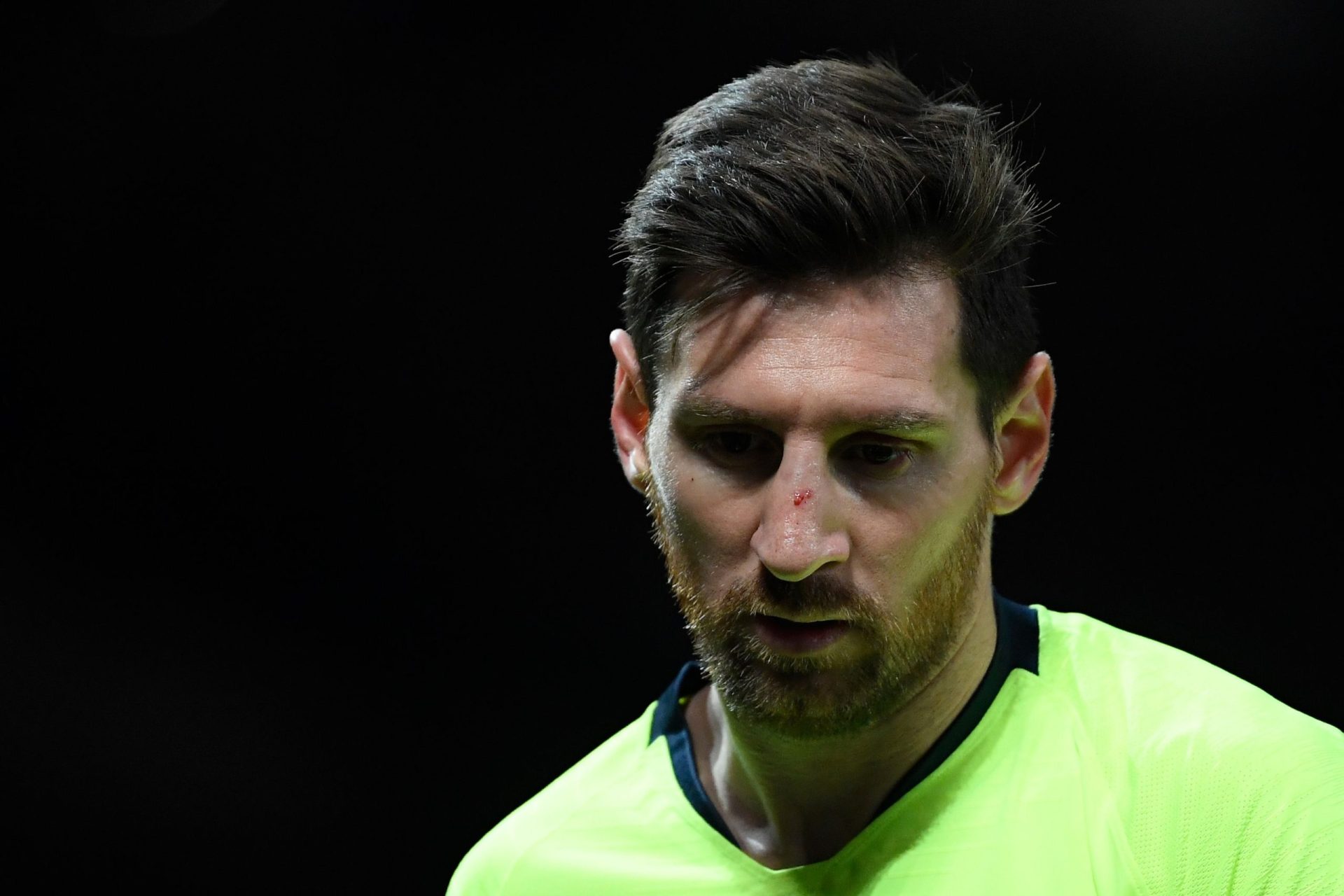 Messi levou cotovelada de Smalling e foi assim que ficou o estado do seu olho&#8230; | FOTO