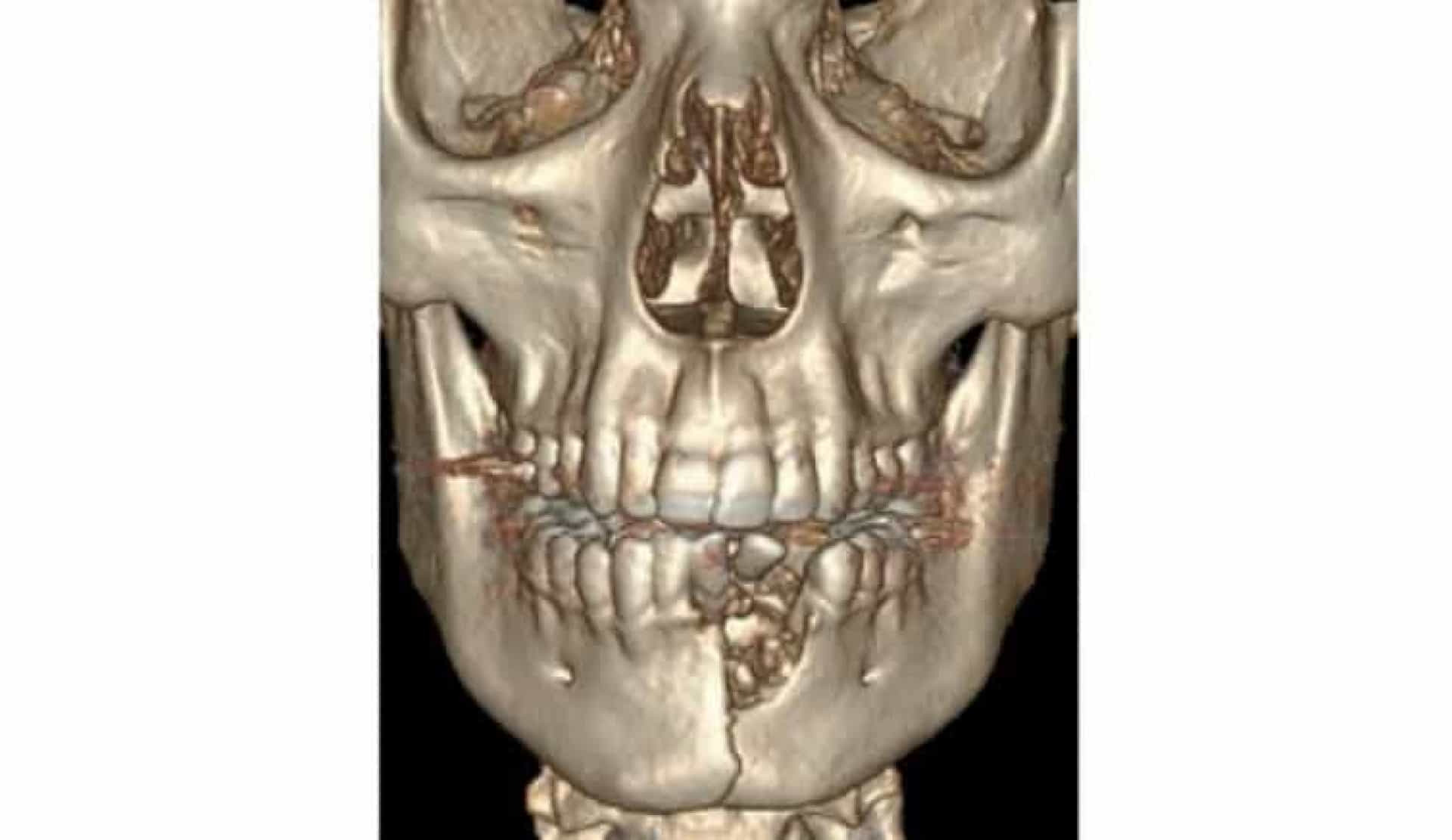 Jovem fica com mandíbula fraturada e sem vários dentes após explosão de cigarro eletrónico