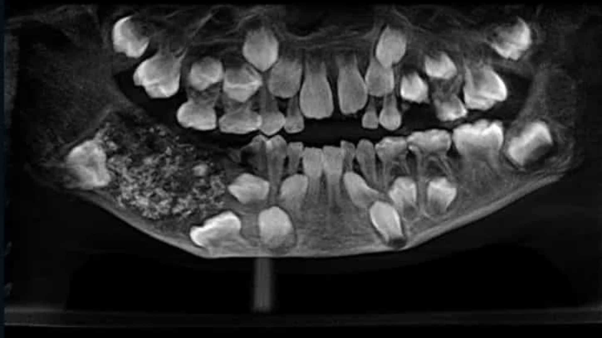 Criança de sete anos que se queixava de dores no maxilar tinha 526 dentes na boca