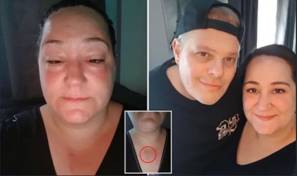 Mulher fica com a cara desfigurada depois de ser picada por aranha durante a noite