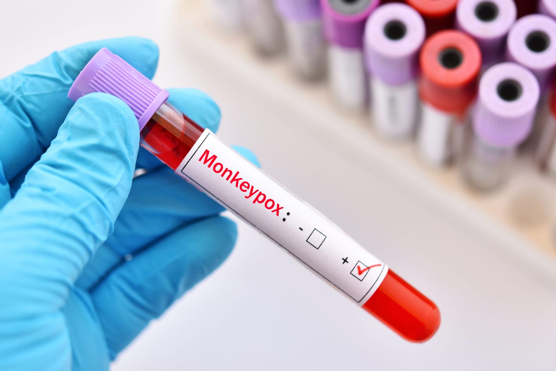 DGS confirma mais 13 casos de infeção pelo vírus Monkeypox