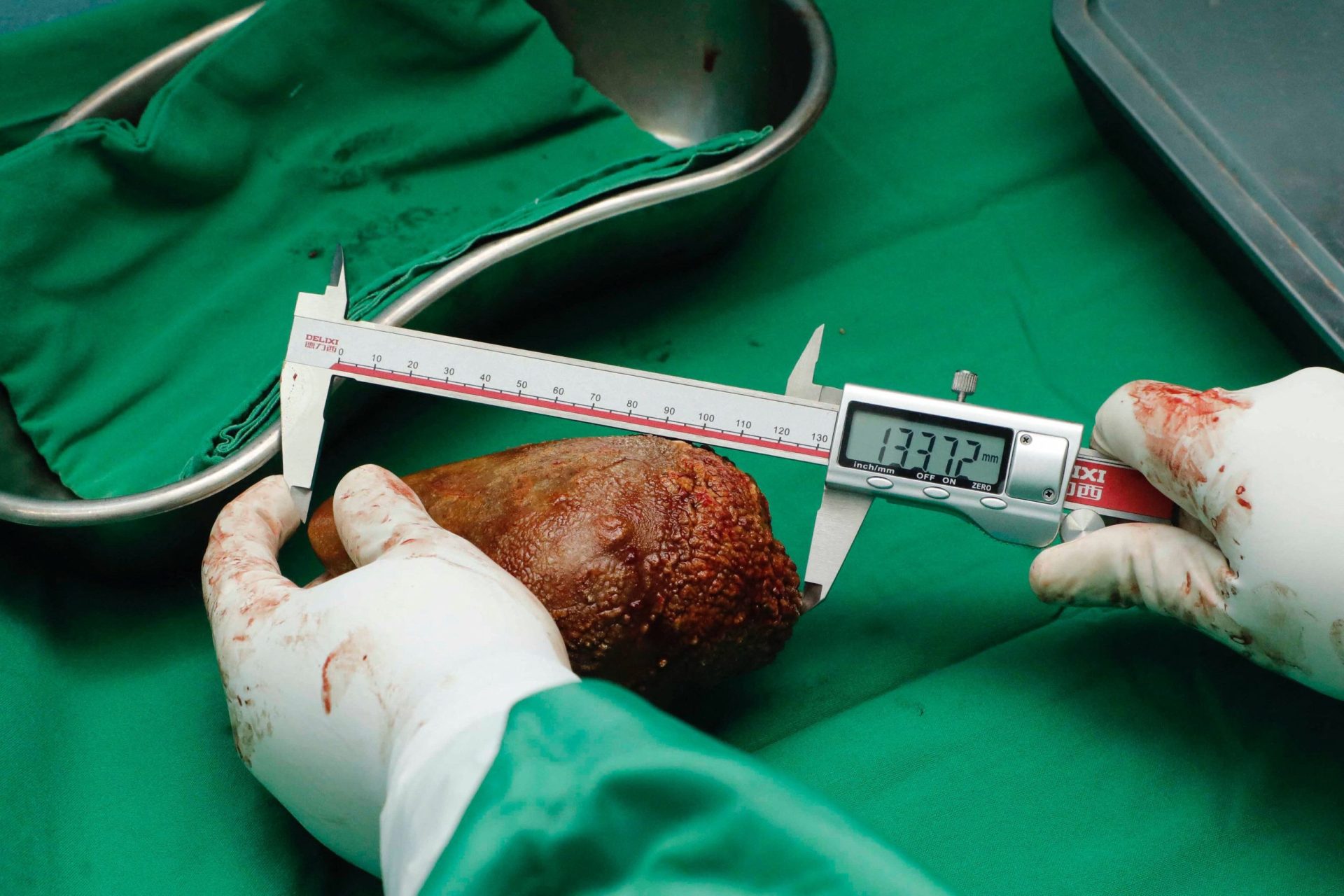 Removida maior pedra nos rins do Mundo em cirurgia no Sri Lanka