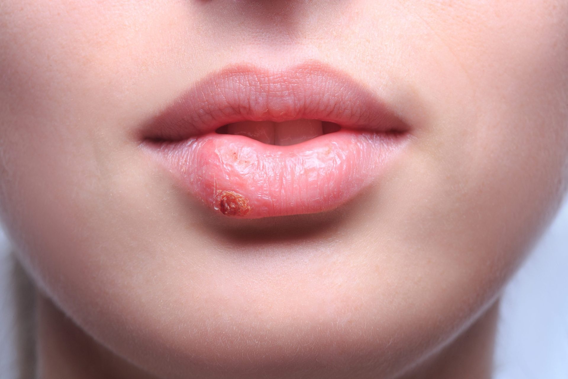 Sabia que tem mais de 50% de hipóteses de ter herpes?