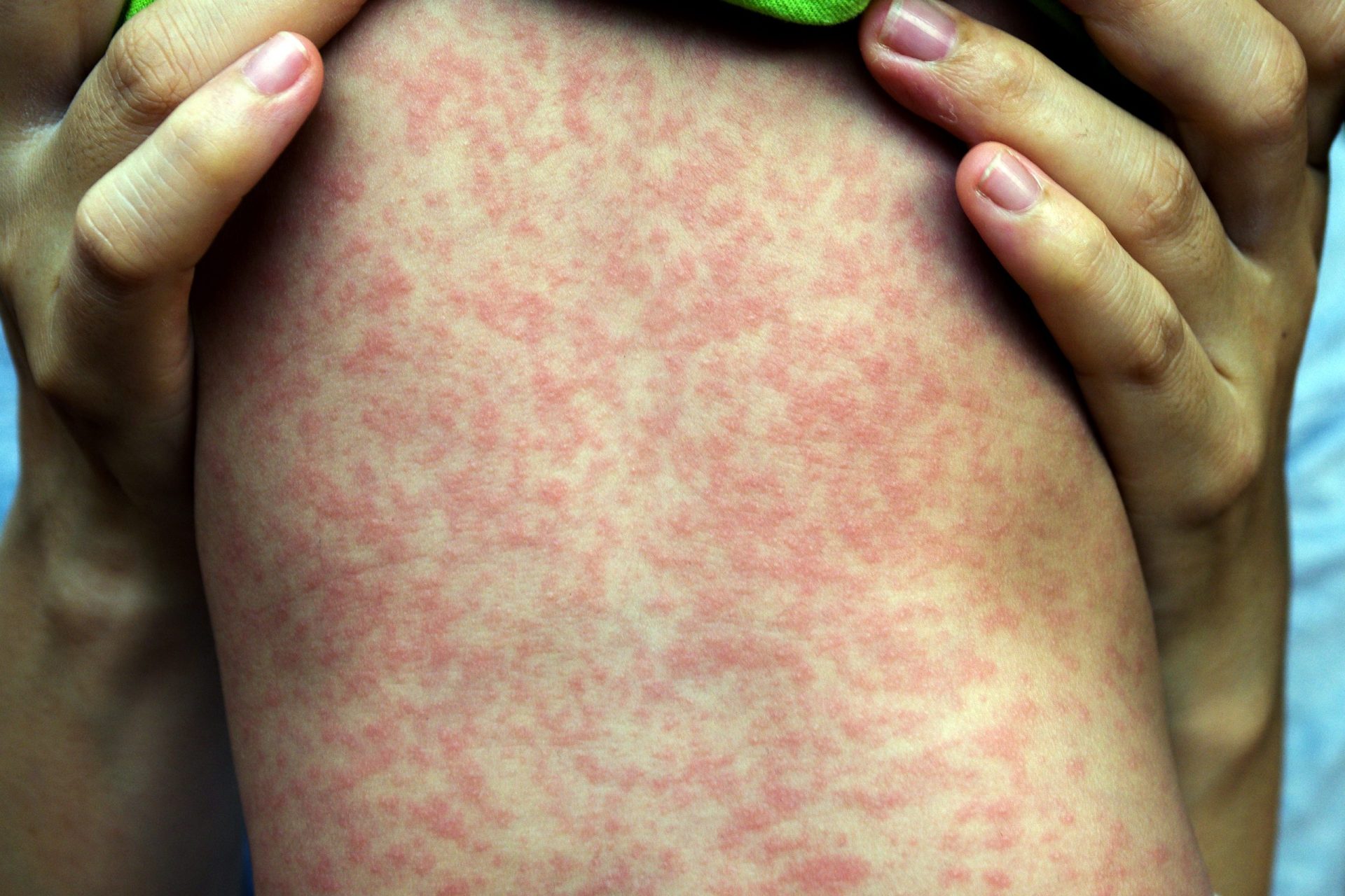 O que precisa de saber sobre o sarampo