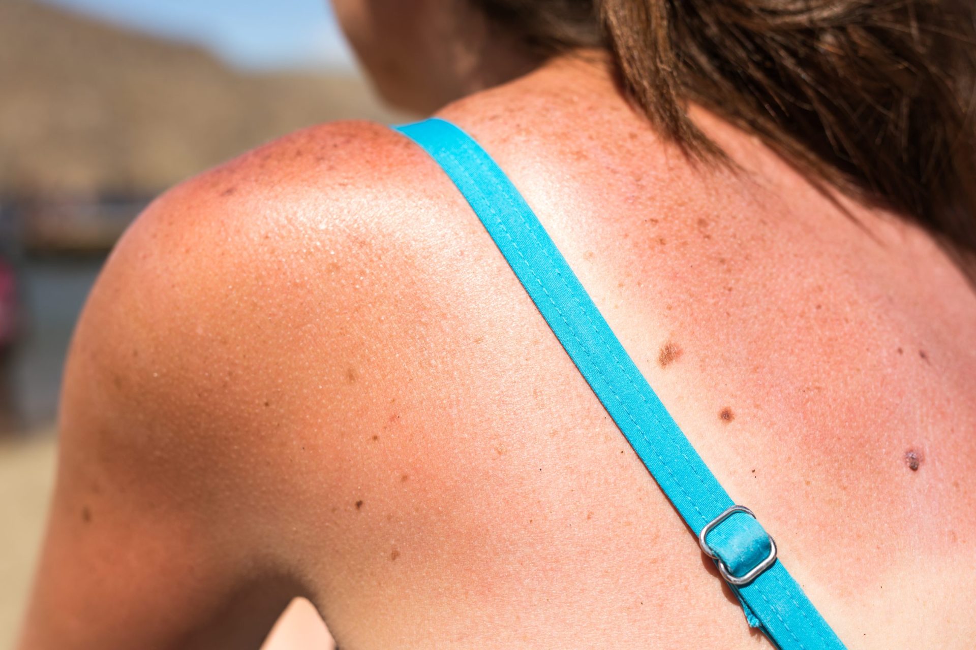 Sabe distinguir queimaduras de alergias ao sol?