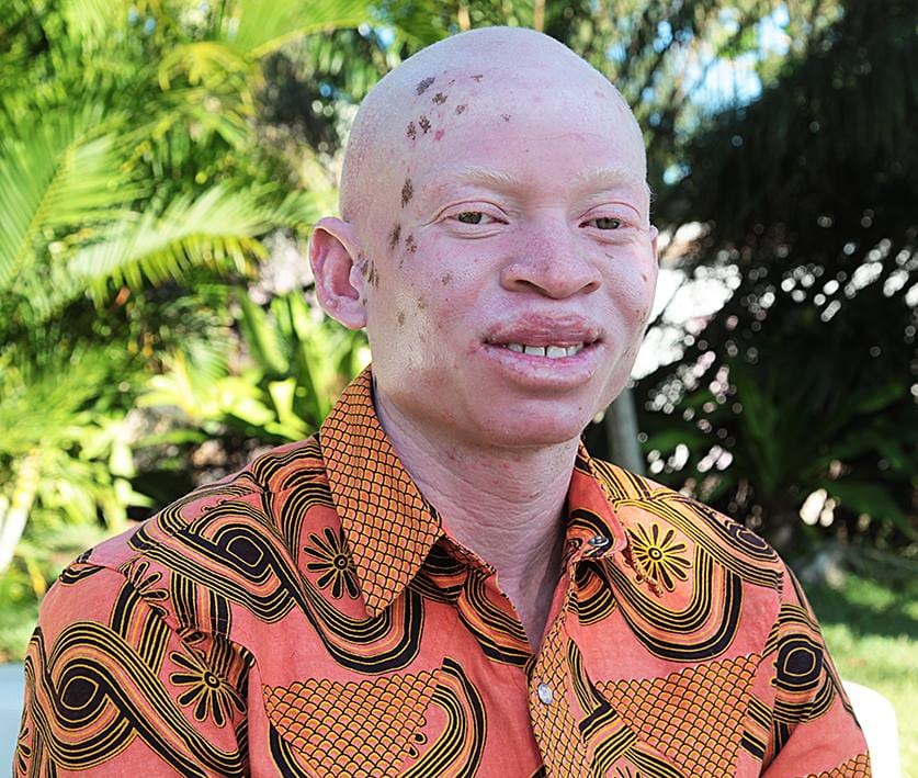 Pessoas com albinismo ainda enfrentam exclusão social em Moçambique