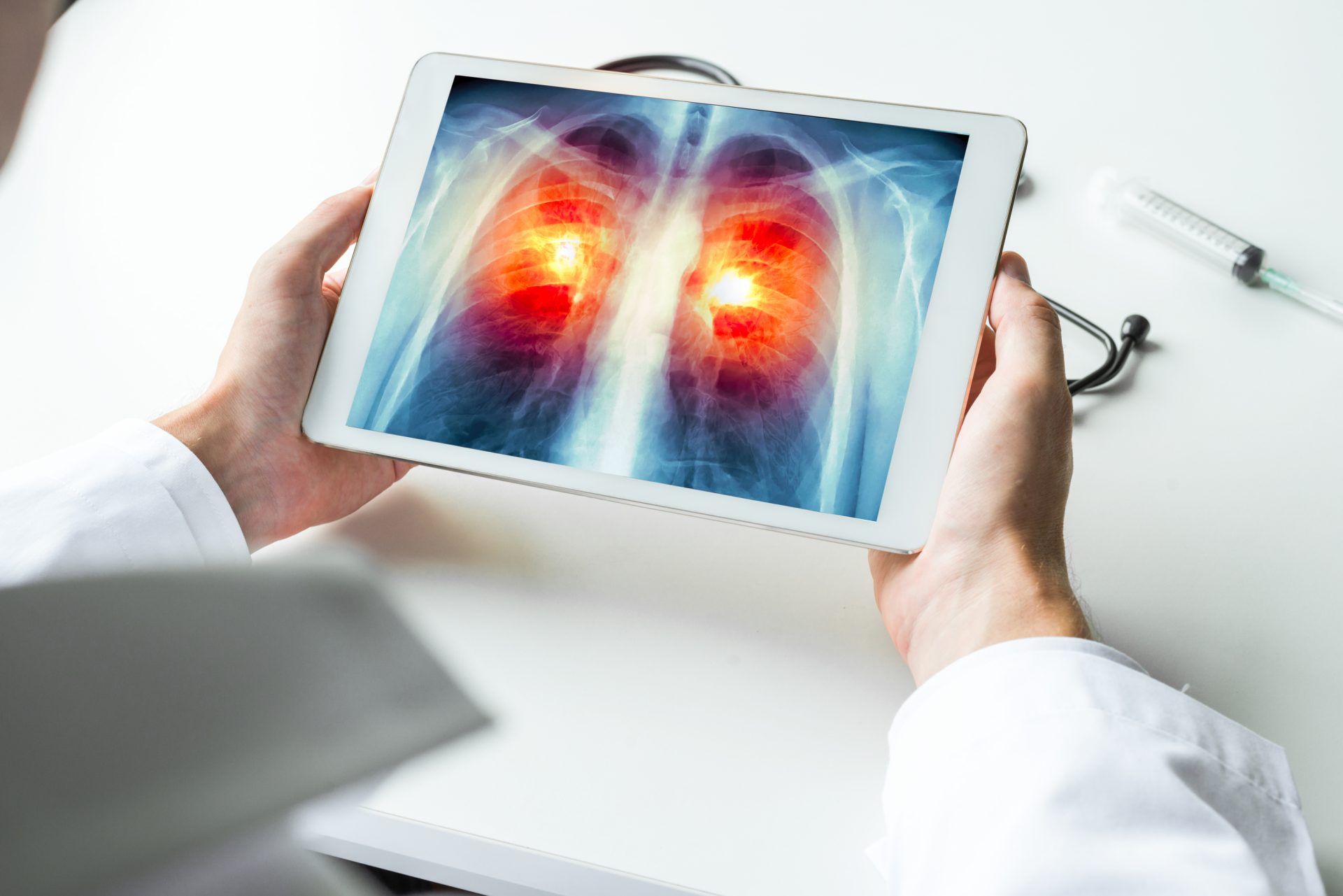 Sociedade Portuguesa de Pneumologia: “Estamos no nível zero” na luta contra cancro do pulmão