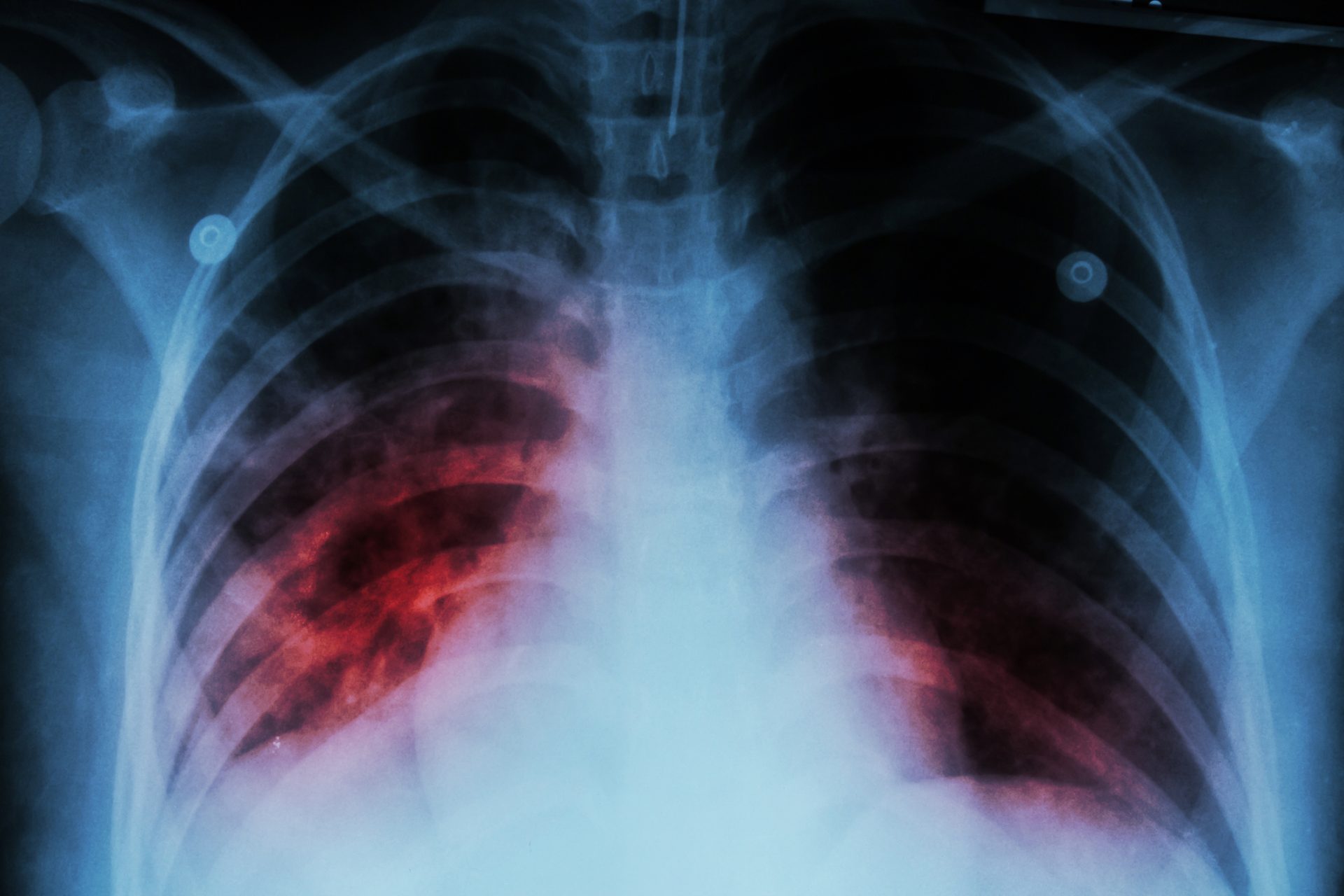 Europa. Mais 7.000 mortes do que expectável por tuberculose entre 2020 e 2022 