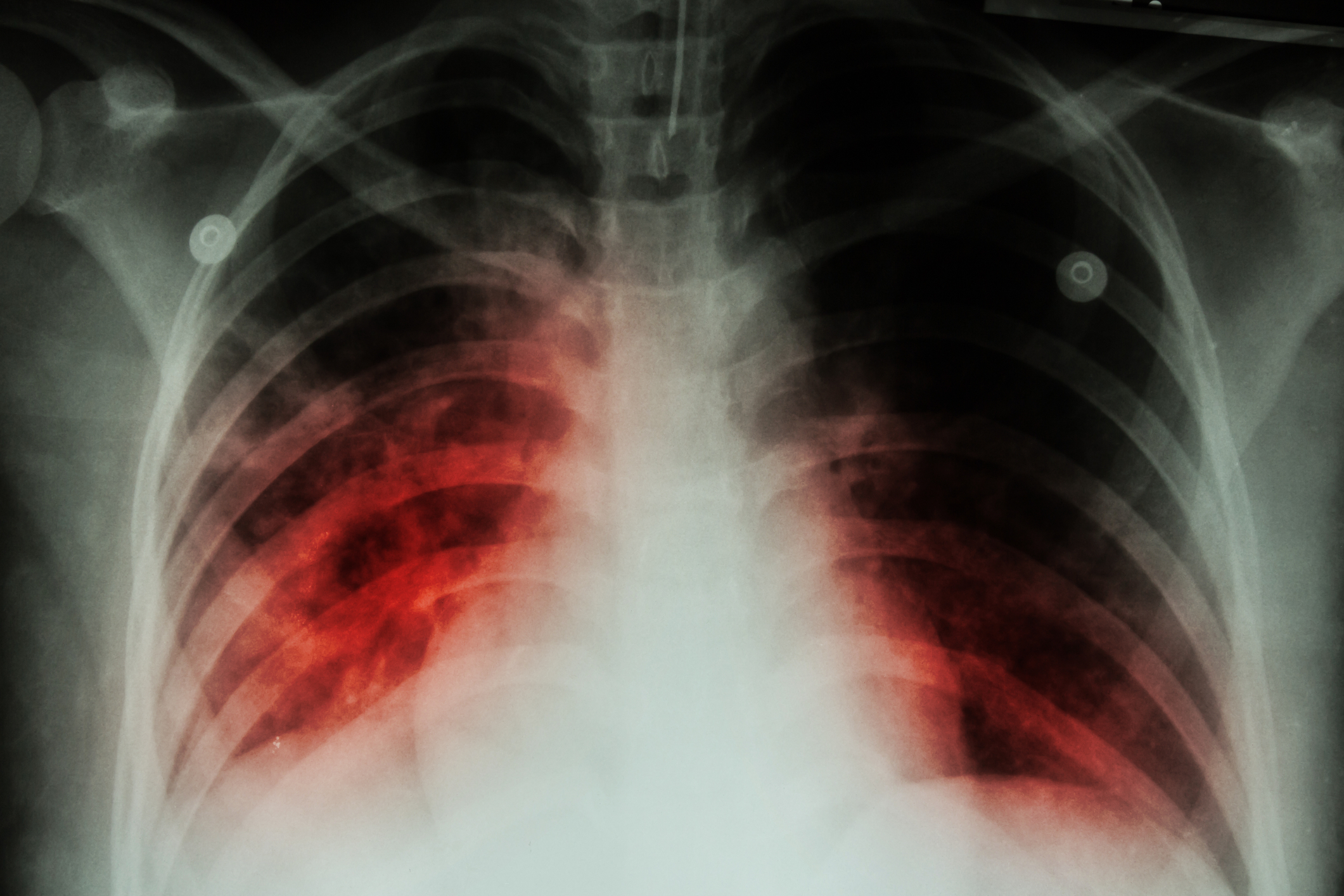 Tuberculose matou 1,2 milhões de pessoas em 2023